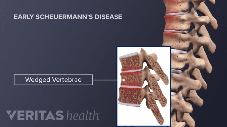 Profile view of wedged vertebrae in Early Scheuermann's Disease