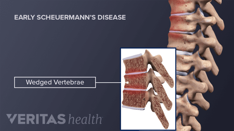 Profile view of wedged vertebrae in Early Scheuermann's Disease