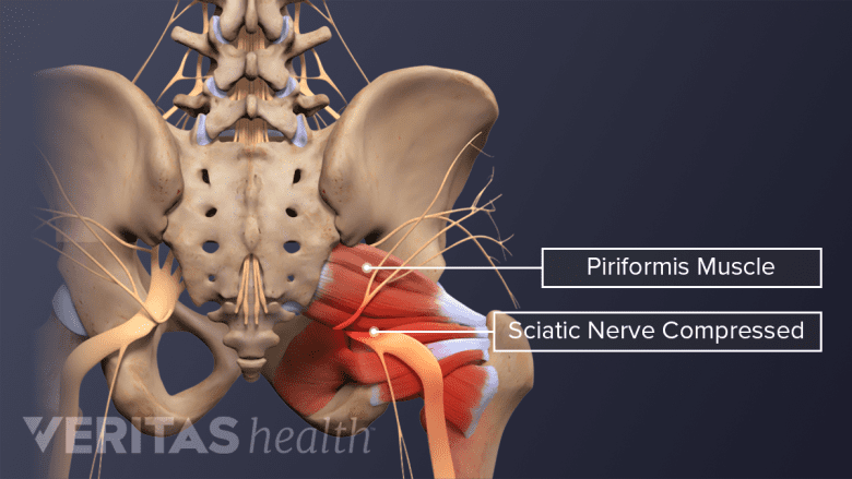 An illustration showing compressed sciatic nerve due to pressure within muscles.