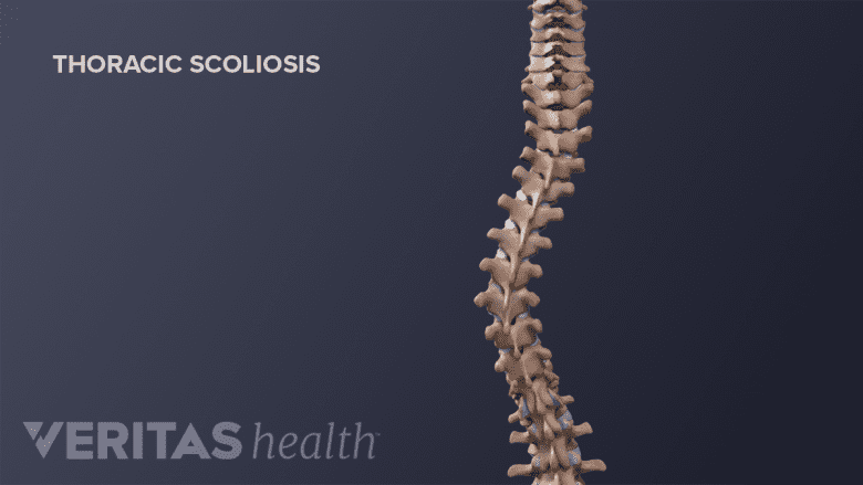 Medical illustration showing adult spine with scoliosis.