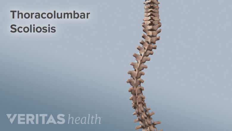 Illustration showing severe spine curvature.