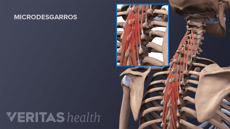 Microdesgarros de los músculos de la espalda.