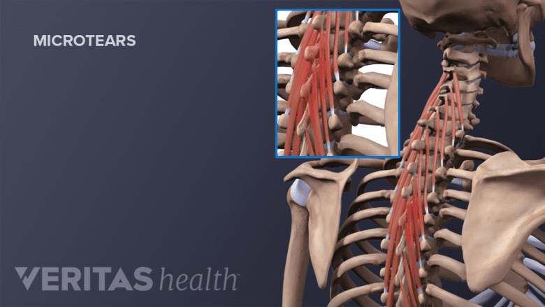 An illustration showing a adult spine with muscle tear in upper back region.