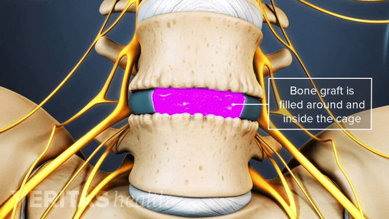 Illustration showing bone graft in fusion surgery.