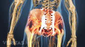 Posterior view of pelvis with ankylosing spondylitis sacroiliitis