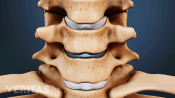 Anterior view of cervical spine showing disc replacement.