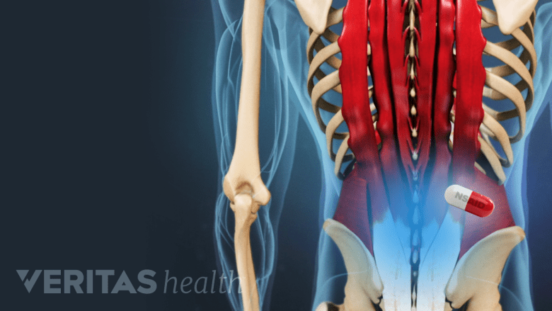 Illustration showing posterior view of lower back with blue highlight and an icon of a pill.