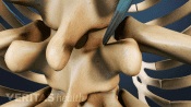 Balloon Tamp insertion in the thoracic spine.
