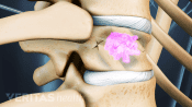 Medical illustration showing bone cement being inserted into a fractured vertebra