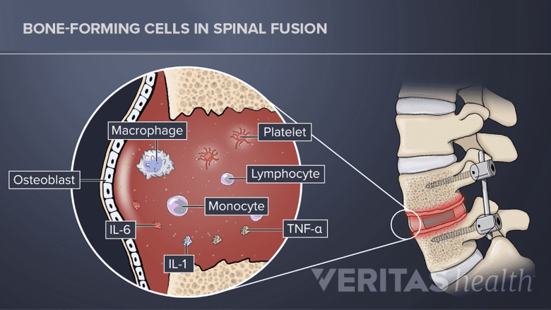 Illustration showing bone healing after lumbar spine fusion.
