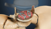 Superior view of ACDF device in S1 vertebra.