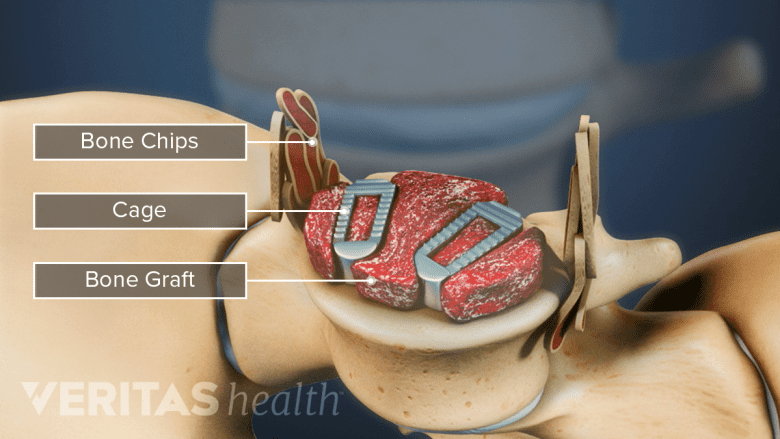 Illustration showing bone graft placed in and around the cage in plif surgery.