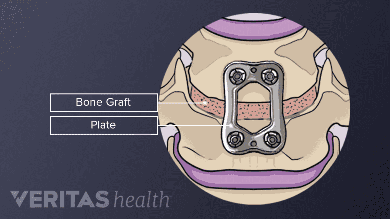 Pedicle screws and rods used for spinal fusion in the neck.