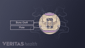Illustration of fusion highlighting the bone graft and plate.