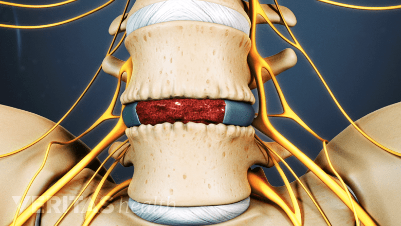 Bone graft filled into a disc space in the lower back.