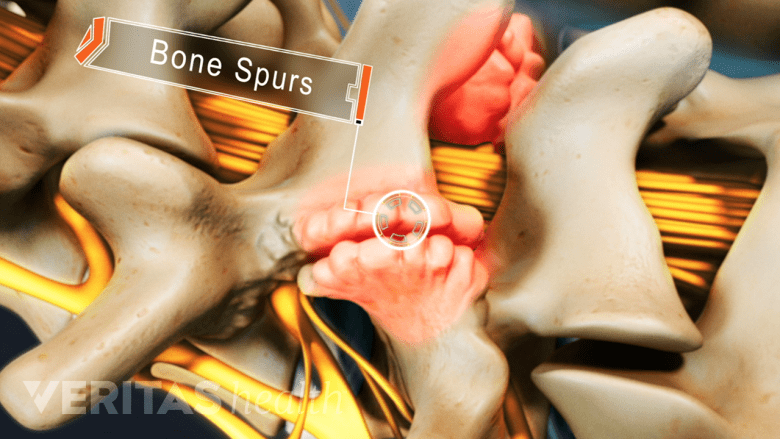 Posterior view of the spine showing bone spurs on facet joints.