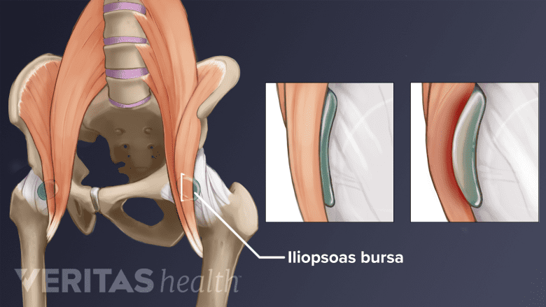 Illustration of the hips with an expanded section of a bursa.