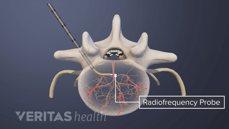 Radiofrequency probe injection into a basivertebral nerve.