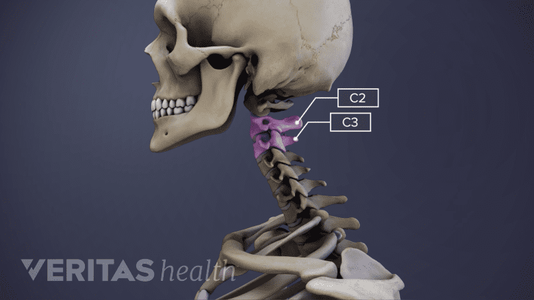 Medical illustration showing cervical spine with C2-C3 highlighted in pink.
