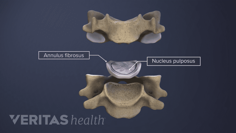 Núcleo de etiquetado del disco espinal, raíz nerviosa, anillo y vértebra lumbar.