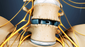 Posterior view of the lumbar spine with with an artificial disc.