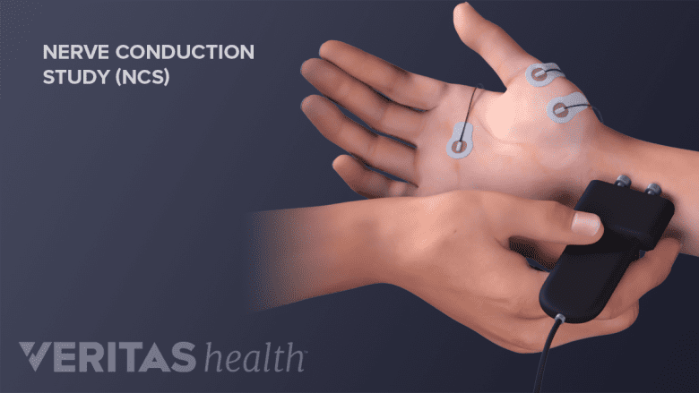 Illustration showing a hand with some electrodes attached performing nerve conduction study.