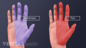 Numbness and pain in the palmar view of the hand