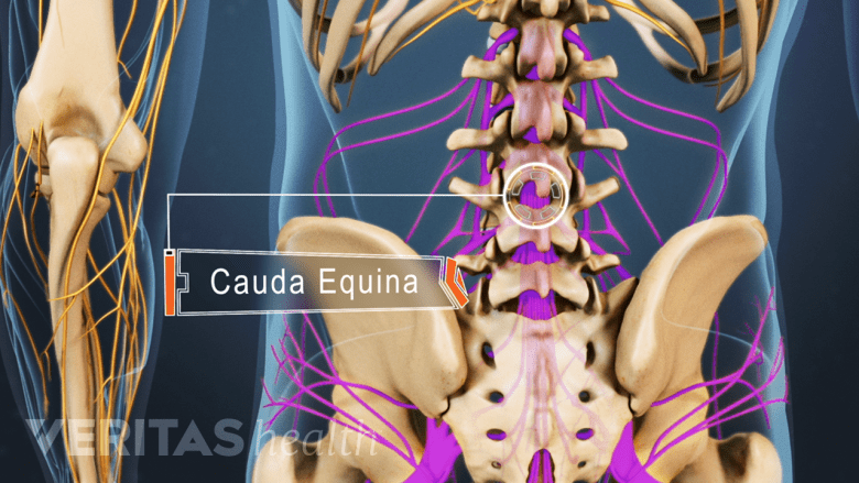 On the left: a midsagittal view of the cauda equina compressed by a herniated lumbar disc. On the right: a superior cross sectional view of the same herniation from above.