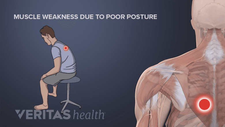 Illustration showing a man and muscle model with a red dot on the upper back region.