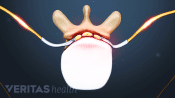 lateral herniation of a thoracic spinal disc
