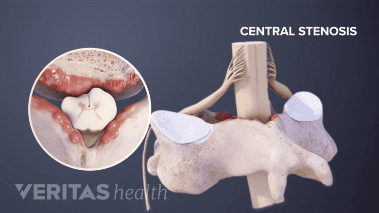 Illustration showing cross-section of cervical spine in a inset and posterior view of cervical spine.