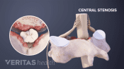 Medical illustration of a vertebrae showing spinal stenosis.