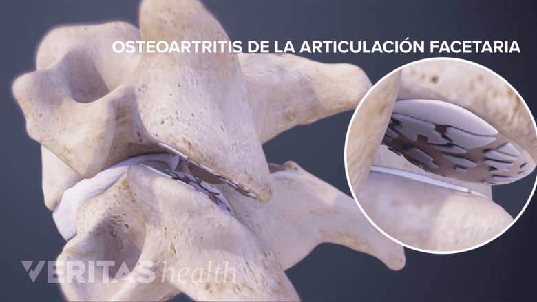 Osteoartritis de la articulación facetaria.