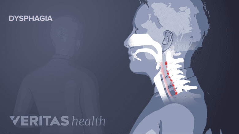 Illustration showing side view of head and neck with red highlights in the neck showing difficulty swallowing.