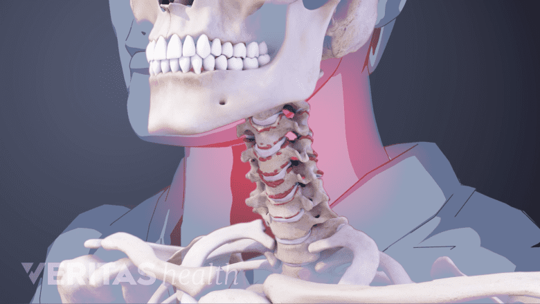 Illustration showing cervical vertebrae with bone spurs andred highlight on the neck.