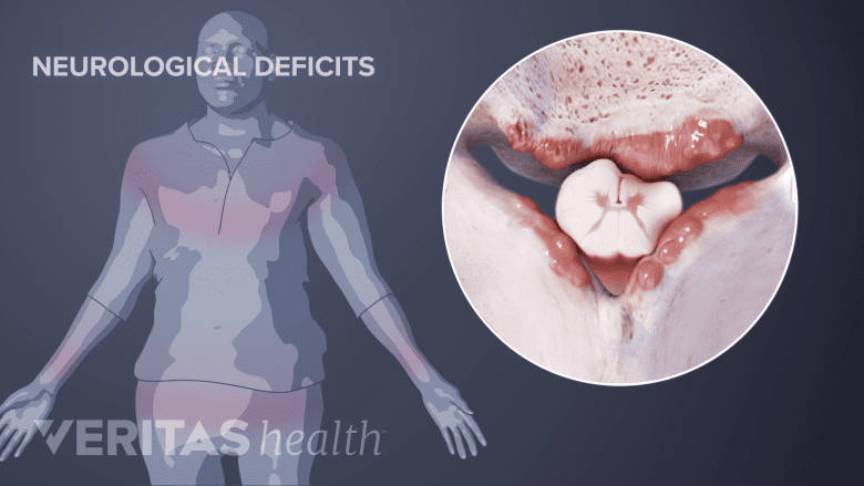 Illustration showing cervical vertebra with osteophytes(bone spurs).