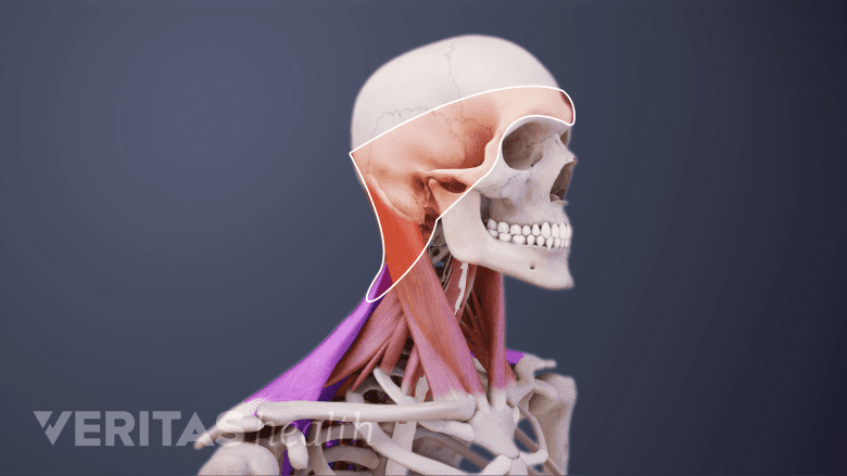 Illustration showing tension headache.