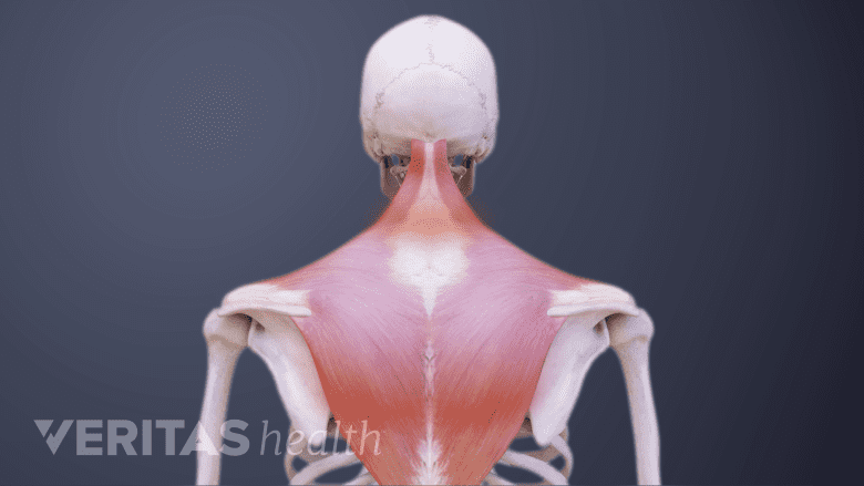 Illustration showing posterior view of stiff neck muscle.