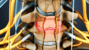 Anterior view of cervical spine showing degenerated disc.