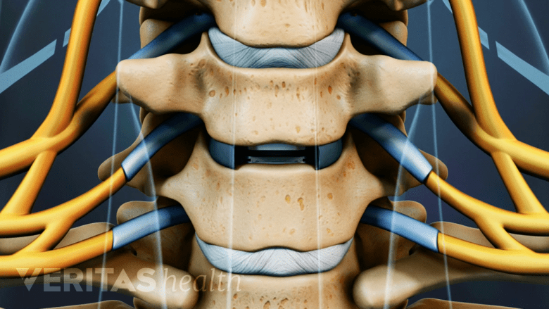 Anterior 3D image of an artificial cervical disc.