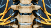 Medical illustration of two vertebrae. The disc between the vertebrae has been removed in preparation for a disc replacement