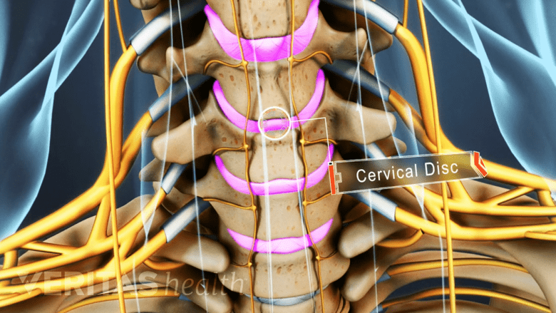 Spinal disc labeling nucleus, nerve root, annulus, and lumbar vertebra.
