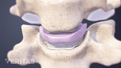 Anterior view of two vertebrae showing the disc between them.