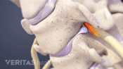 Cervical herniated disc
