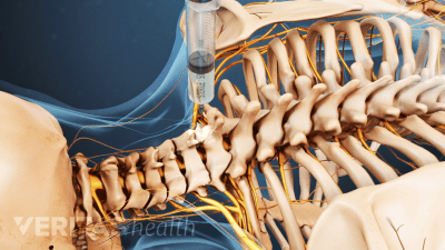 Posterior view of cervical and thoracic spine showing steroid anesthetic injection.