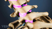 Spinal Stenosis in the cervical spine showing synovial fluid in the facet joints.