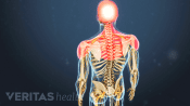 Medical illustration of a skeleton. The shoulders and arms are highlighted in red indicating pain, numbness or tingling.