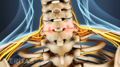 Posterior view of cervical spine showing facet joint swelling from osteoarthritis.