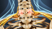Posterior view of the cervical spine showing osteoarthritis.