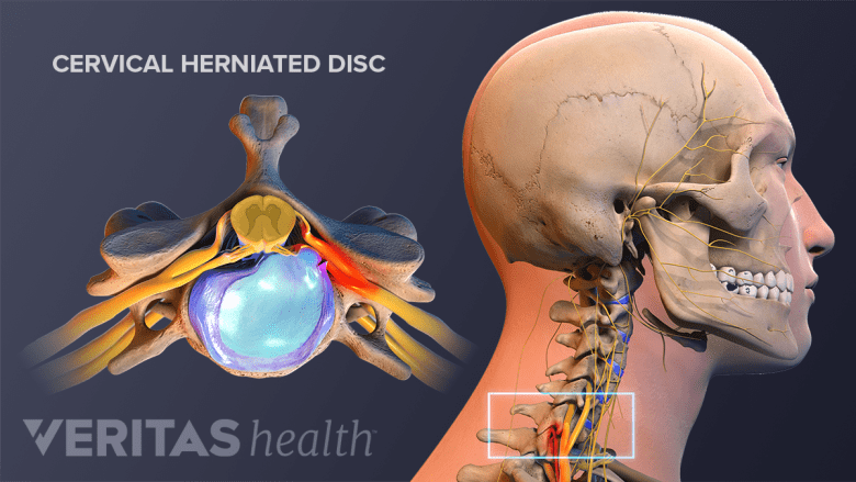 Illustration showing head and neck anatomy and a cervical vertebra with herniation.